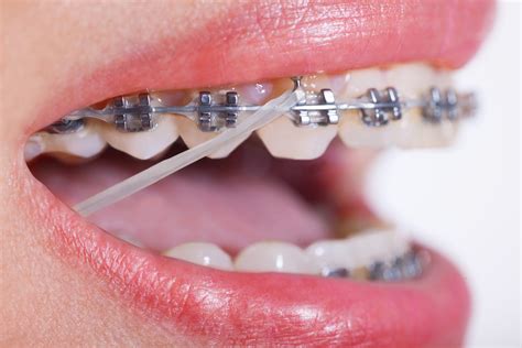 underbite metal bracket rubber bands not braces invisalign|rubber bands for underbite.